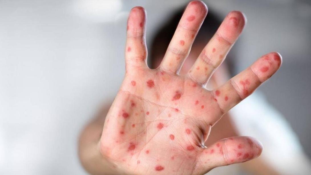 Affenpocken erhält einen neuen Namen: Mpox